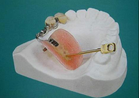 精密附件種類圖譜 精密附件種類圖譜