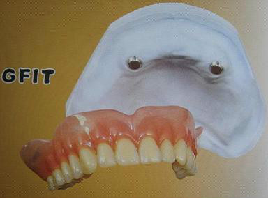 精密附件種類圖譜 精密附件種類圖譜