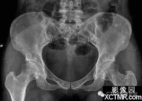 種植遇到骨島怎么辦 種植遇到骨島怎么辦