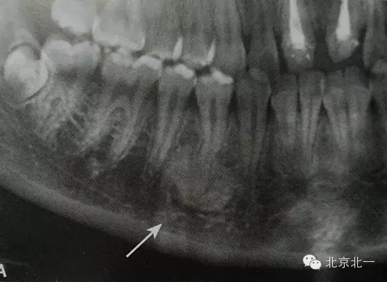 種植遇到骨島怎么辦 種植遇到骨島怎么辦