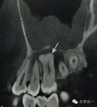 種植遇到骨島怎么辦 種植遇到骨島怎么辦