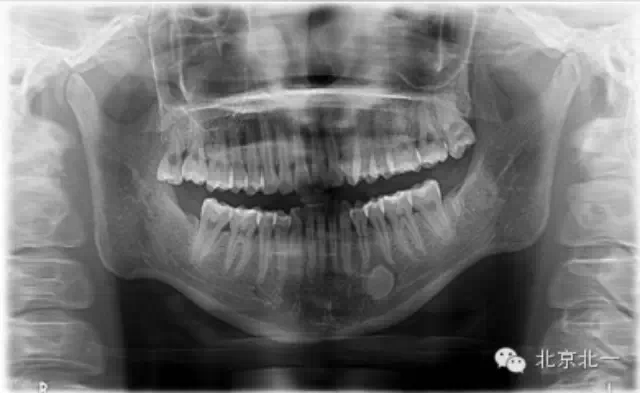 種植遇到骨島怎么辦 種植遇到骨島怎么辦