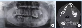 頜骨良性成牙骨質細胞瘤 頜骨良性成牙骨質細胞瘤