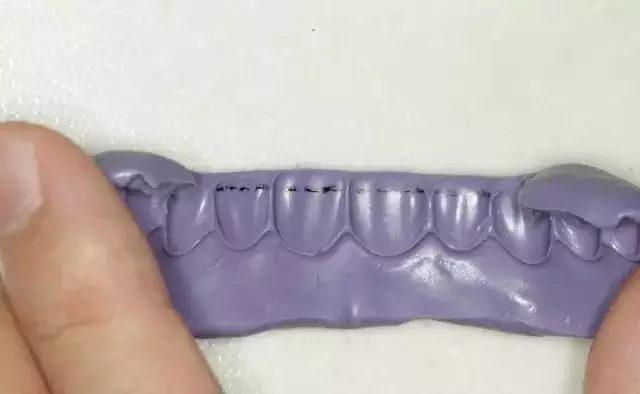 硅橡膠導(dǎo)板——牙體預(yù)備步驟詳解 硅橡膠導(dǎo)板——牙體預(yù)備步驟詳解