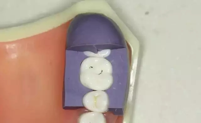 硅橡膠導(dǎo)板——牙體預(yù)備步驟詳解 硅橡膠導(dǎo)板——牙體預(yù)備步驟詳解