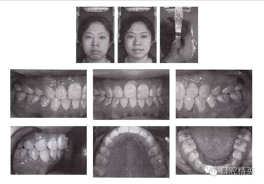 拔牙矯治開頜伴前突 拔牙矯治開頜伴前突