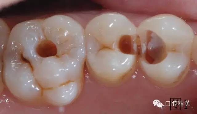 橡皮障在樹脂充填的應(yīng)用 橡皮障在樹脂充填的應(yīng)用