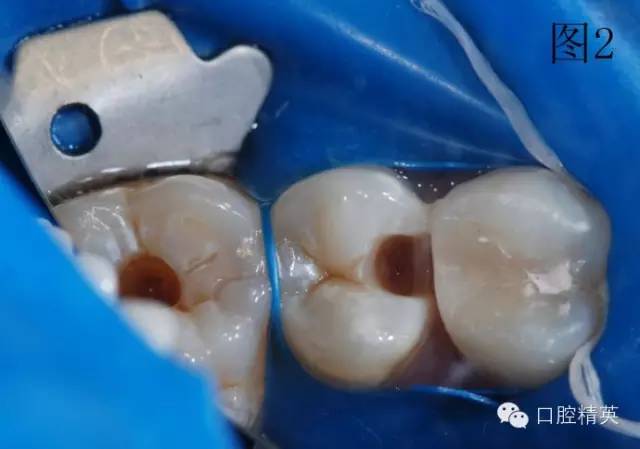 橡皮障在樹脂充填的應(yīng)用 橡皮障在樹脂充填的應(yīng)用