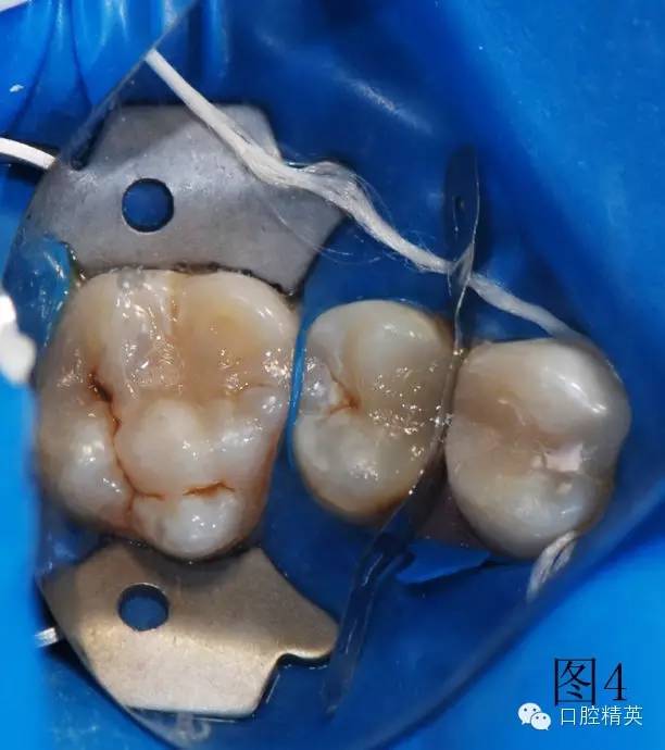 橡皮障在樹脂充填的應(yīng)用 橡皮障在樹脂充填的應(yīng)用