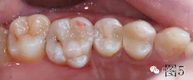 橡皮障在樹脂充填的應(yīng)用 橡皮障在樹脂充填的應(yīng)用