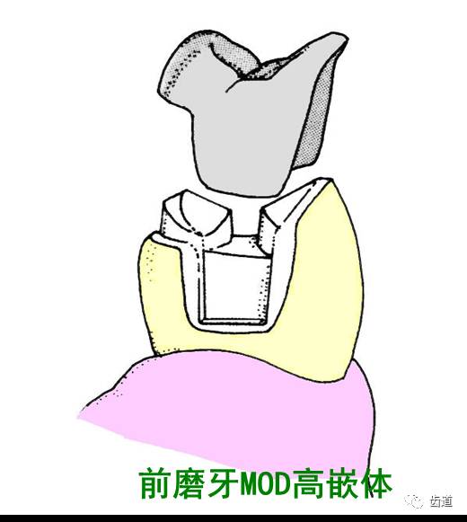 高嵌體的牙體預(yù)備 高嵌體的牙體預(yù)備
