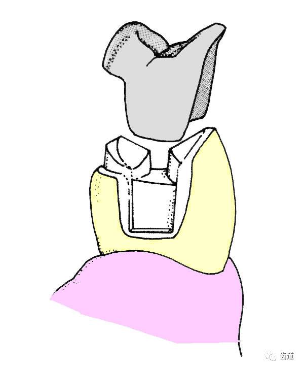 高嵌體的牙體預(yù)備 高嵌體的牙體預(yù)備