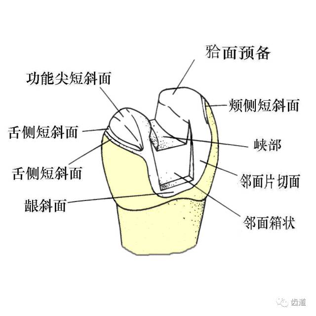 高嵌體的牙體預(yù)備 高嵌體的牙體預(yù)備