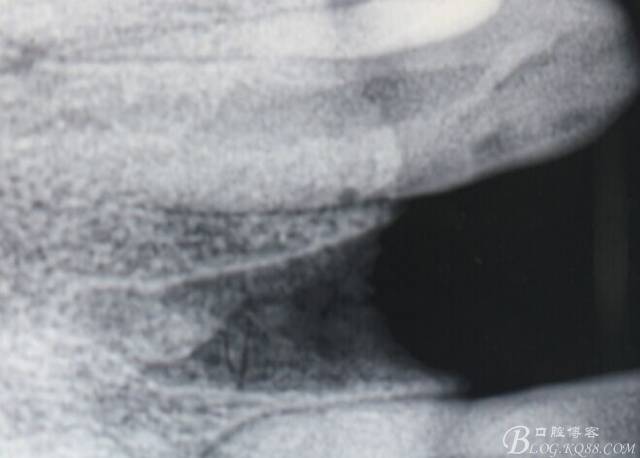 【征文大賽】一例上前牙種植失敗病例的補(bǔ)救--梁光強(qiáng) 【征文大賽】一例上前牙種植失敗病例的補(bǔ)救--梁光強(qiáng)
