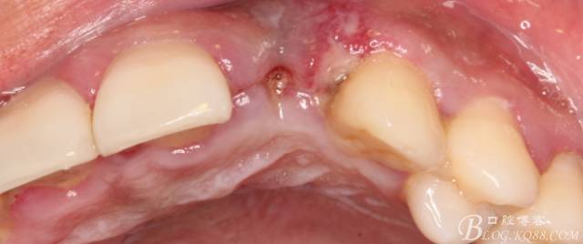 【征文大賽】一例上前牙種植失敗病例的補(bǔ)救--梁光強(qiáng) 【征文大賽】一例上前牙種植失敗病例的補(bǔ)救--梁光強(qiáng)