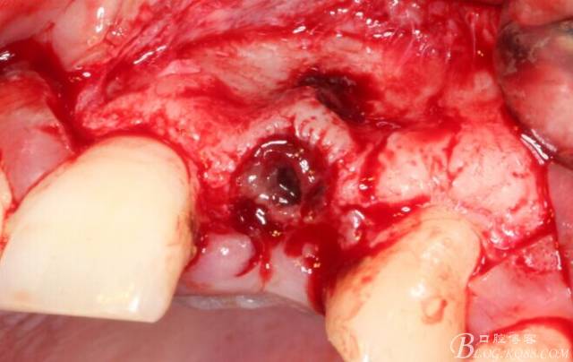 【征文大賽】一例上前牙種植失敗病例的補(bǔ)救--梁光強(qiáng) 【征文大賽】一例上前牙種植失敗病例的補(bǔ)救--梁光強(qiáng)