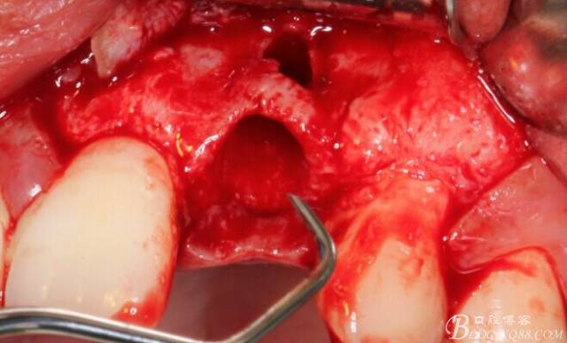 【征文大賽】一例上前牙種植失敗病例的補(bǔ)救--梁光強(qiáng) 【征文大賽】一例上前牙種植失敗病例的補(bǔ)救--梁光強(qiáng)