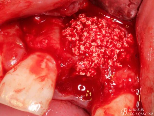 【征文大賽】一例上前牙種植失敗病例的補(bǔ)救--梁光強(qiáng) 【征文大賽】一例上前牙種植失敗病例的補(bǔ)救--梁光強(qiáng)