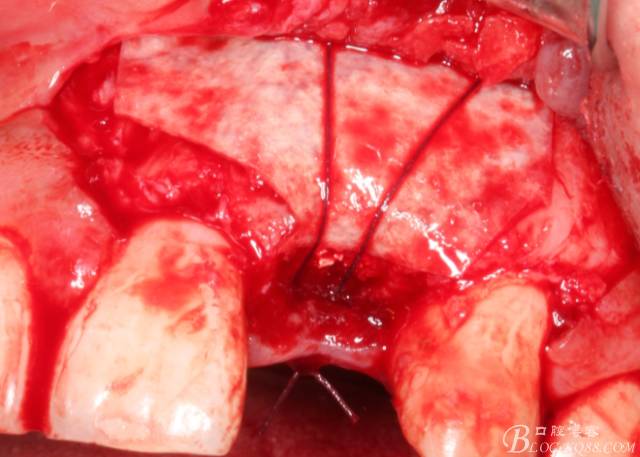 【征文大賽】一例上前牙種植失敗病例的補(bǔ)救--梁光強(qiáng) 【征文大賽】一例上前牙種植失敗病例的補(bǔ)救--梁光強(qiáng)