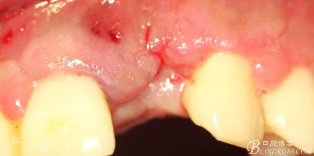 【征文大賽】一例上前牙種植失敗病例的補(bǔ)救--梁光強(qiáng) 【征文大賽】一例上前牙種植失敗病例的補(bǔ)救--梁光強(qiáng)