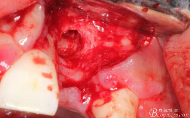 【征文大賽】一例上前牙種植失敗病例的補(bǔ)救--梁光強(qiáng) 【征文大賽】一例上前牙種植失敗病例的補(bǔ)救--梁光強(qiáng)