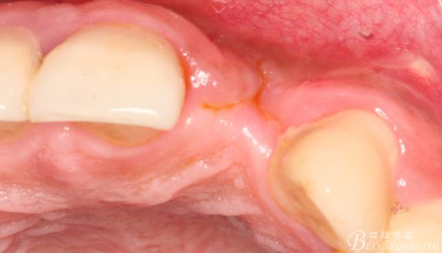 【征文大賽】一例上前牙種植失敗病例的補(bǔ)救--梁光強(qiáng) 【征文大賽】一例上前牙種植失敗病例的補(bǔ)救--梁光強(qiáng)