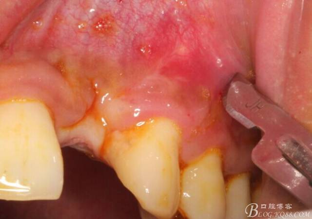 【征文大賽】一例上前牙種植失敗病例的補(bǔ)救--梁光強(qiáng) 【征文大賽】一例上前牙種植失敗病例的補(bǔ)救--梁光強(qiáng)