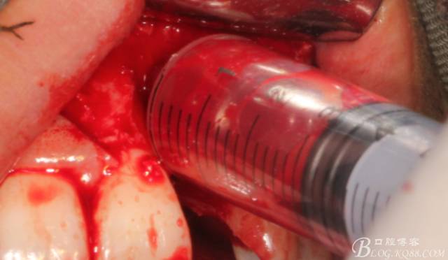 【征文大賽】一例上前牙種植失敗病例的補(bǔ)救--梁光強(qiáng) 【征文大賽】一例上前牙種植失敗病例的補(bǔ)救--梁光強(qiáng)