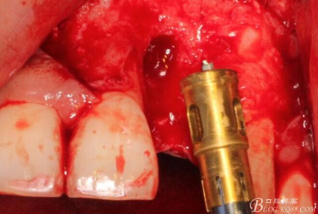 【征文大賽】一例上前牙種植失敗病例的補(bǔ)救--梁光強(qiáng) 【征文大賽】一例上前牙種植失敗病例的補(bǔ)救--梁光強(qiáng)