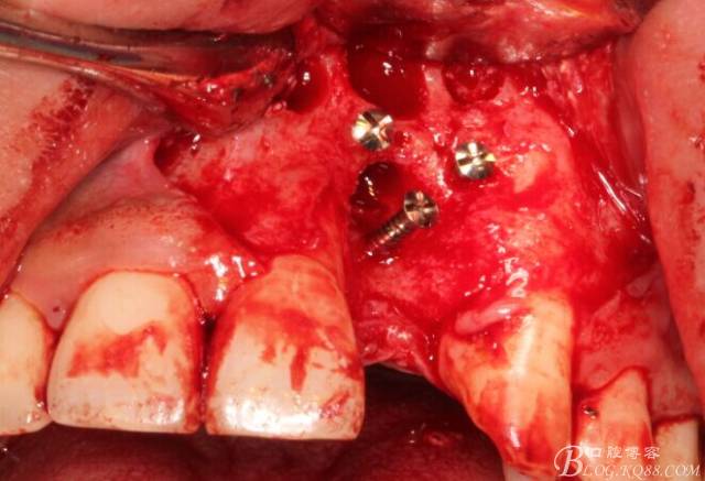 【征文大賽】一例上前牙種植失敗病例的補(bǔ)救--梁光強(qiáng) 【征文大賽】一例上前牙種植失敗病例的補(bǔ)救--梁光強(qiáng)