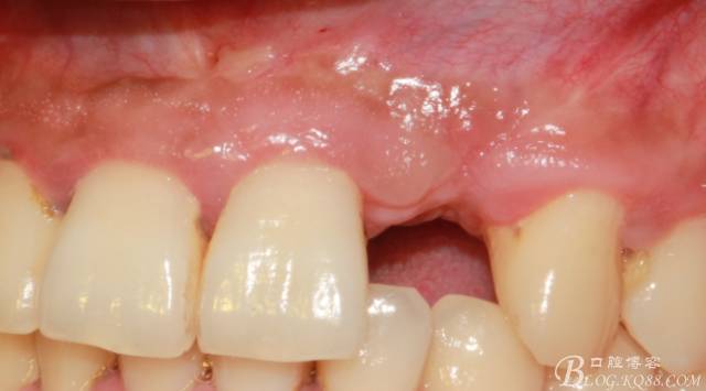 【征文大賽】一例上前牙種植失敗病例的補(bǔ)救--梁光強(qiáng) 【征文大賽】一例上前牙種植失敗病例的補(bǔ)救--梁光強(qiáng)