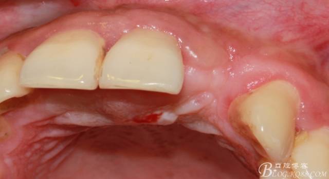 【征文大賽】一例上前牙種植失敗病例的補(bǔ)救--梁光強(qiáng) 【征文大賽】一例上前牙種植失敗病例的補(bǔ)救--梁光強(qiáng)