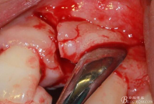 【征文大賽】一例上前牙種植失敗病例的補(bǔ)救--梁光強(qiáng) 【征文大賽】一例上前牙種植失敗病例的補(bǔ)救--梁光強(qiáng)