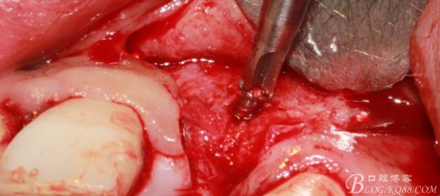 【征文大賽】一例上前牙種植失敗病例的補(bǔ)救--梁光強(qiáng) 【征文大賽】一例上前牙種植失敗病例的補(bǔ)救--梁光強(qiáng)