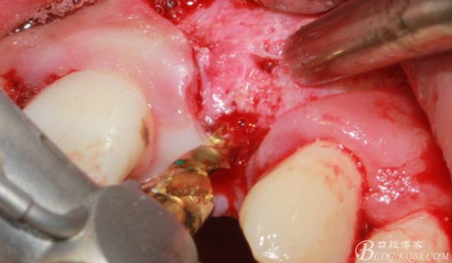 【征文大賽】一例上前牙種植失敗病例的補(bǔ)救--梁光強(qiáng) 【征文大賽】一例上前牙種植失敗病例的補(bǔ)救--梁光強(qiáng)