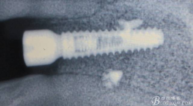 【征文大賽】一例上前牙種植失敗病例的補(bǔ)救--梁光強(qiáng) 【征文大賽】一例上前牙種植失敗病例的補(bǔ)救--梁光強(qiáng)