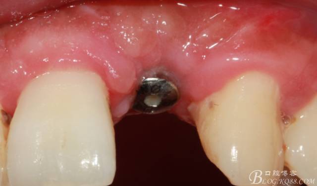 【征文大賽】一例上前牙種植失敗病例的補(bǔ)救--梁光強(qiáng) 【征文大賽】一例上前牙種植失敗病例的補(bǔ)救--梁光強(qiáng)