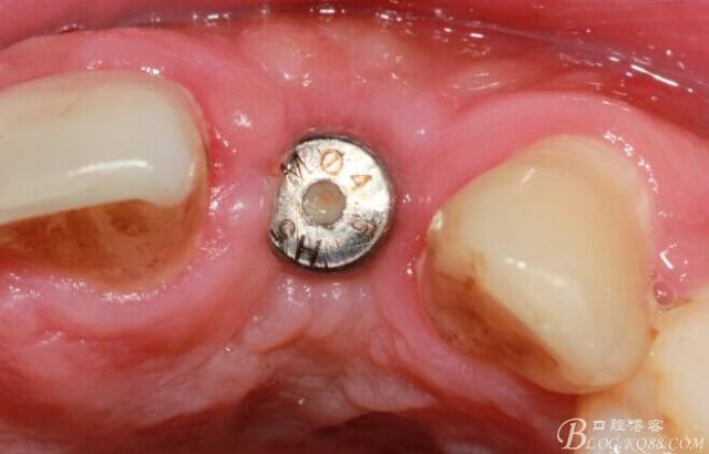 【征文大賽】一例上前牙種植失敗病例的補(bǔ)救--梁光強(qiáng) 【征文大賽】一例上前牙種植失敗病例的補(bǔ)救--梁光強(qiáng)