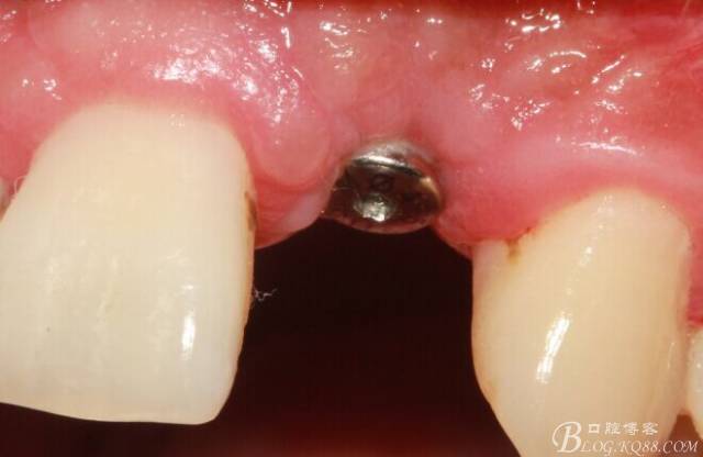 【征文大賽】一例上前牙種植失敗病例的補(bǔ)救--梁光強(qiáng) 【征文大賽】一例上前牙種植失敗病例的補(bǔ)救--梁光強(qiáng)