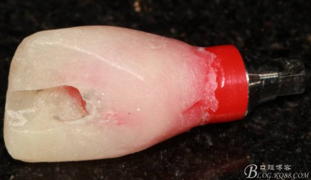 【征文大賽】一例上前牙種植失敗病例的補(bǔ)救--梁光強(qiáng) 【征文大賽】一例上前牙種植失敗病例的補(bǔ)救--梁光強(qiáng)