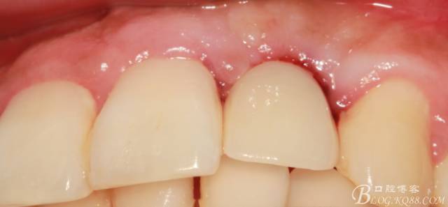 【征文大賽】一例上前牙種植失敗病例的補(bǔ)救--梁光強(qiáng) 【征文大賽】一例上前牙種植失敗病例的補(bǔ)救--梁光強(qiáng)