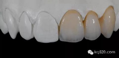 烤瓷牙邊緣變黑，要換新的嗎？