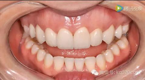 烤瓷牙邊緣變黑，要換新的嗎？