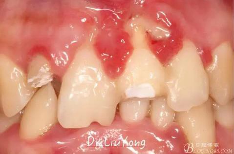 山西牙周劉勇:“前牙外傷患者的口腔多學(xué)科聯(lián)合治療”精彩案例分享 山西牙周劉勇:“前牙外傷患者的口腔多學(xué)科聯(lián)合治療”精彩案例分享