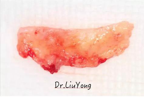 山西牙周劉勇:“前牙外傷患者的口腔多學(xué)科聯(lián)合治療”精彩案例分享 山西牙周劉勇:“前牙外傷患者的口腔多學(xué)科聯(lián)合治療”精彩案例分享