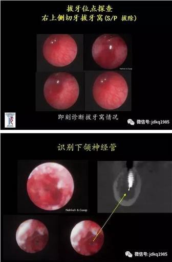 我院口腔種植科引進國內(nèi)首臺口腔種植套管式微型內(nèi)窺鏡 我院口腔種植科引進國內(nèi)首臺口腔種植套管式微型內(nèi)窺鏡