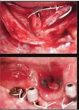 牙醫(yī)引以為戒——日本植牙手術(shù)死亡事件 牙醫(yī)引以為戒——日本植牙手術(shù)死亡事件