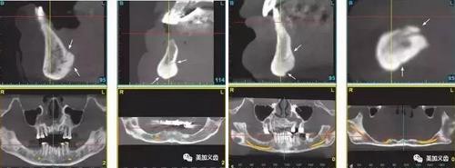 牙醫(yī)引以為戒——日本植牙手術(shù)死亡事件 牙醫(yī)引以為戒——日本植牙手術(shù)死亡事件