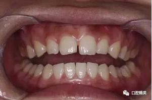 圖解:前牙間隙關閉過程 圖解:前牙間隙關閉過程