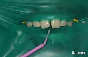 圖解:前牙間隙關閉過程 圖解:前牙間隙關閉過程